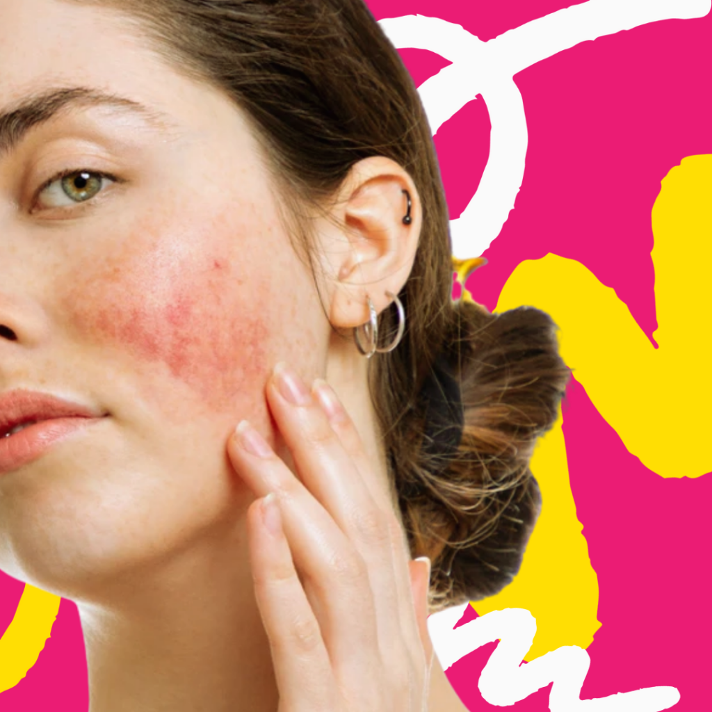 rosacea