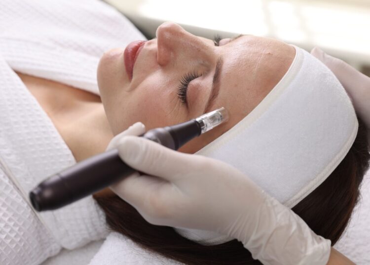 microneedling
